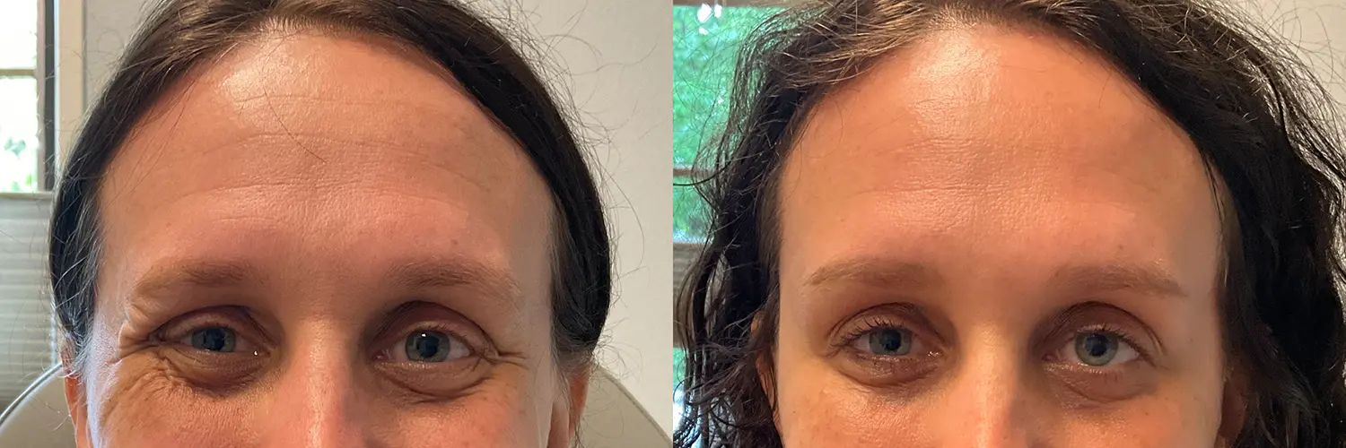 Before and after – Botox – Female patient, age 30-39 – Image 8