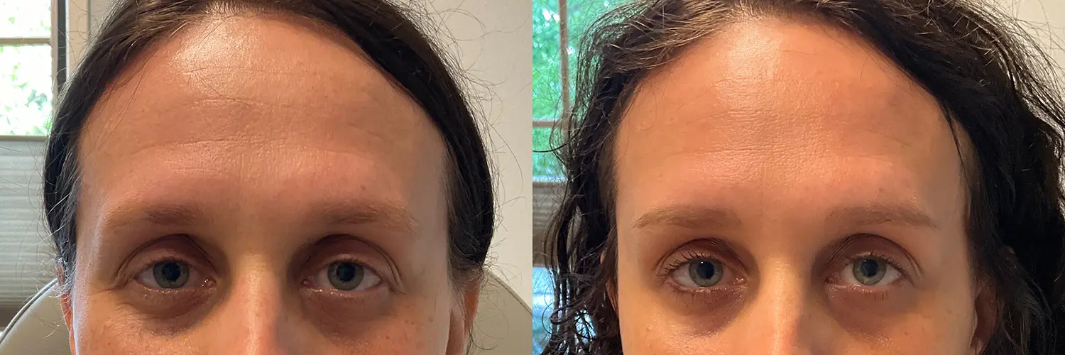 Before and after – Botox – Female patient, age 30-39 – Image 9
