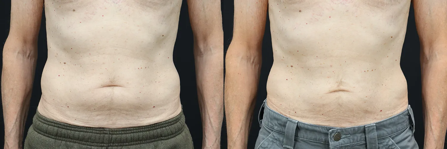 Before and after – Male Surgery – Male patient, age 30-39 – Image 13