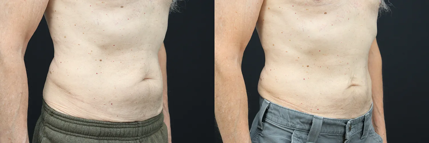 Before and after – Male Surgery – Male patient, age 30-39 – Image 14