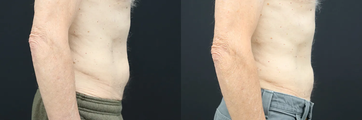 Before and after – Male Surgery – Male patient, age 30-39 – Image 15