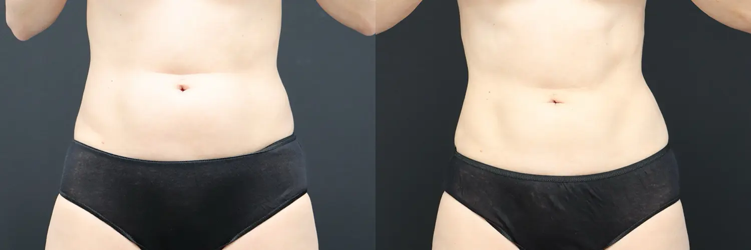 Before and after – Coolsculpting – Female patient, age 20-29 – Image 10