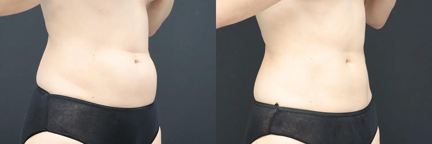 Before and after – Coolsculpting – Female patient, age 20-29 – Image 11