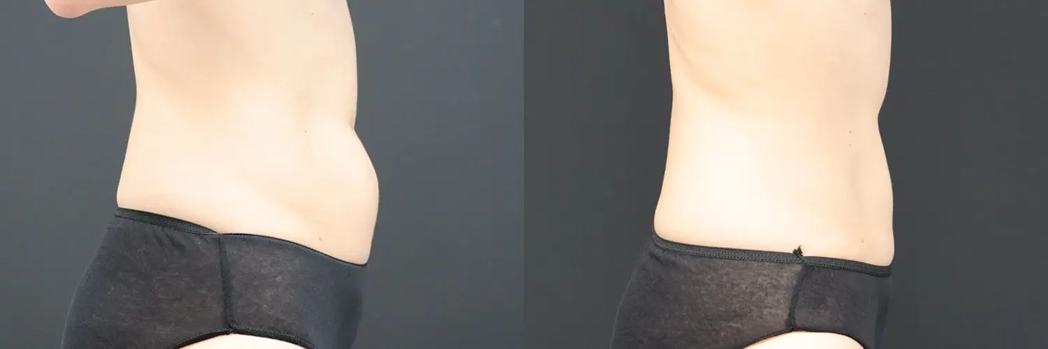 Before and after – Coolsculpting – Female patient, age 20-29 – Image 12