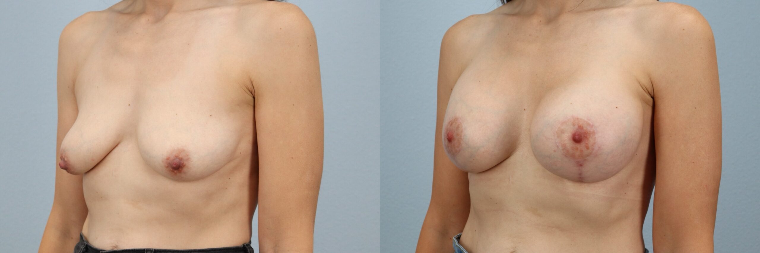 Before and after – Breast Lift With Implants – Female patient, age 40-49 – Image 32