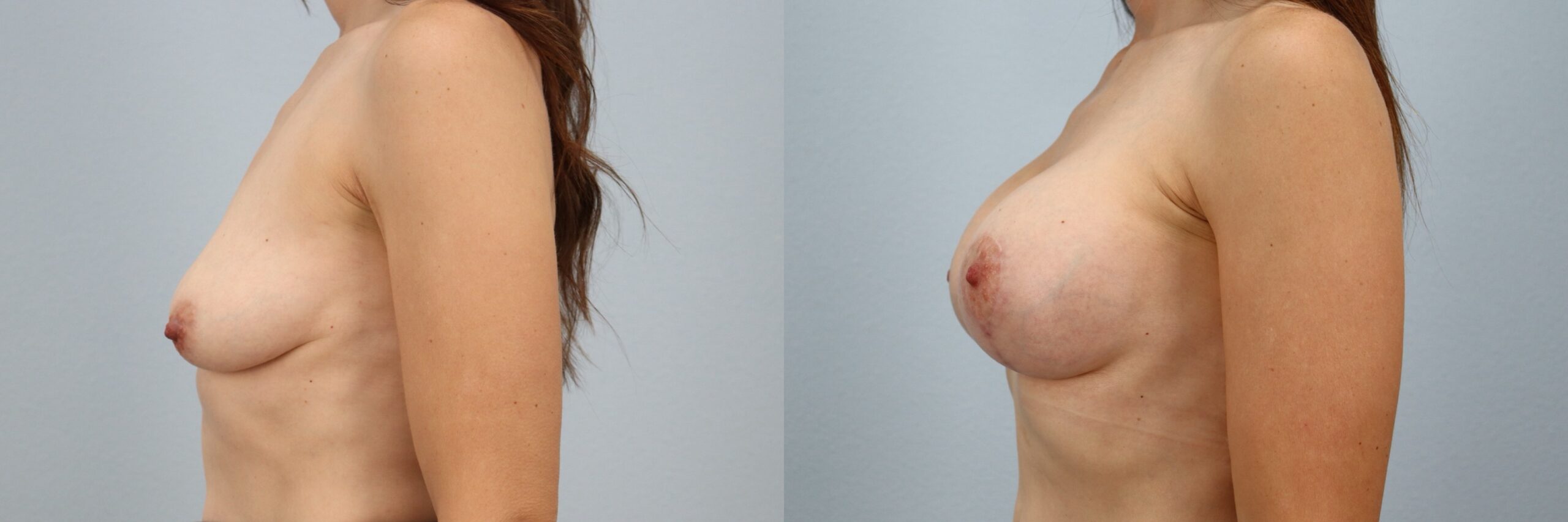 Before and after – Breast Lift With Implants – Female patient, age 40-49 – Image 33