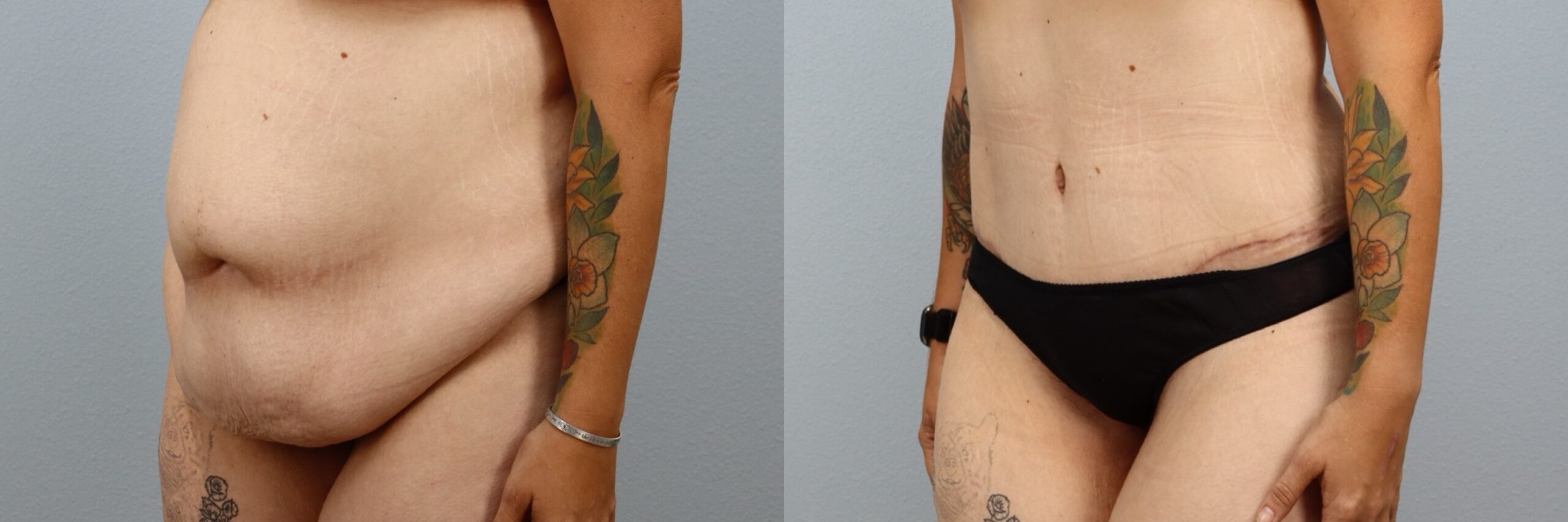 Before and after – Weight Loss Transformation – Female patient, age 30-39 – Image 47