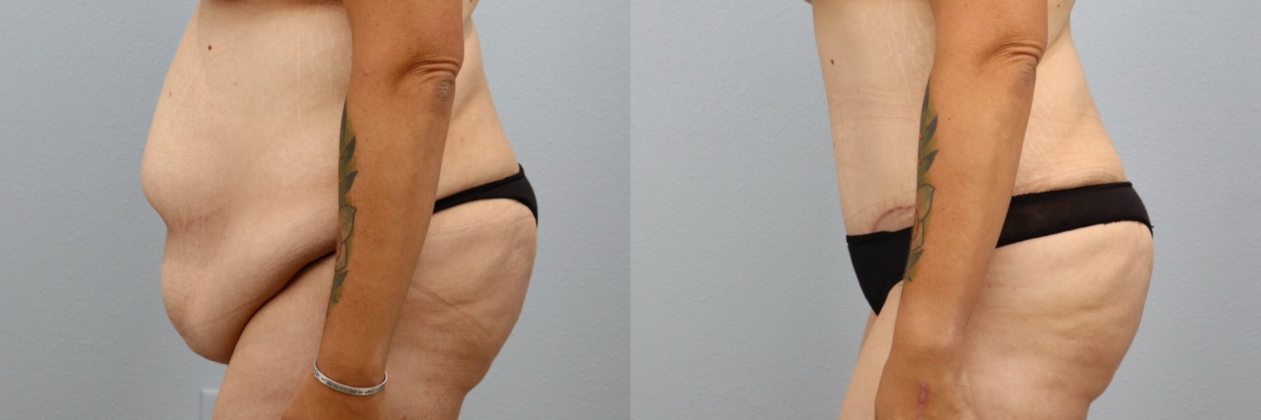 Before and after – Weight Loss Transformation – Female patient, age 30-39 – Image 48