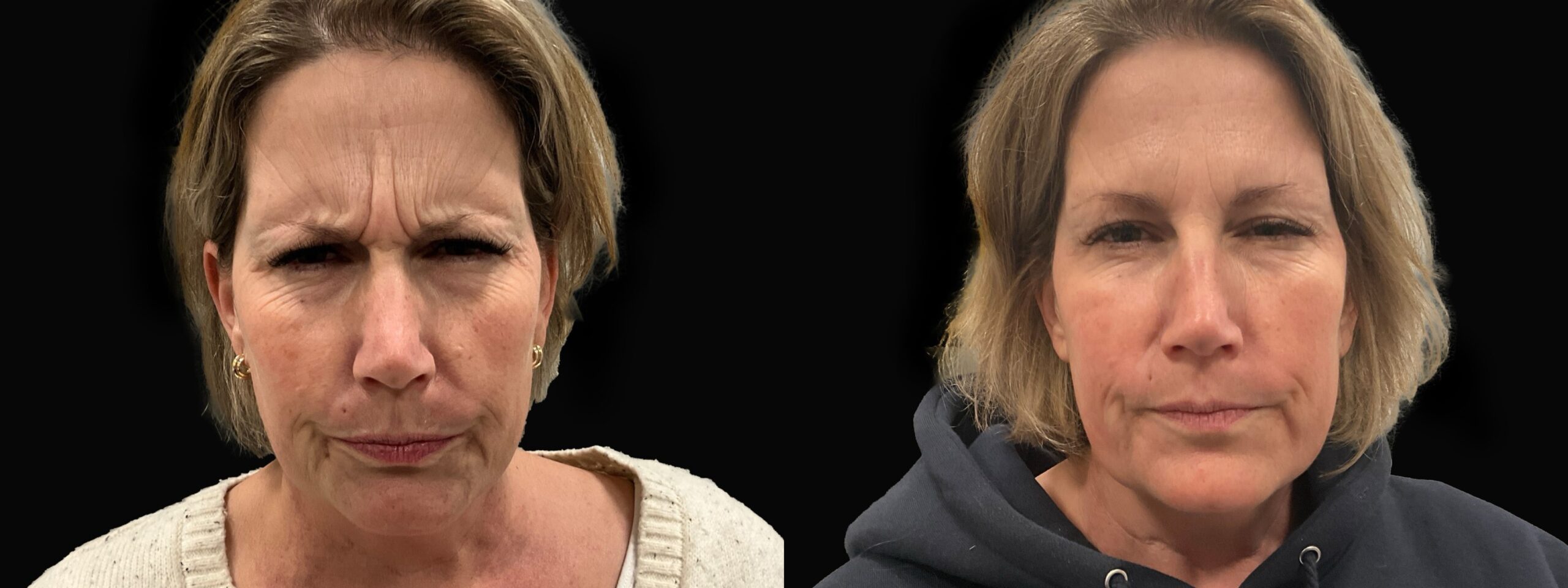 Before and after – BOTOX – Female patient, age 50-59 – Image 30
