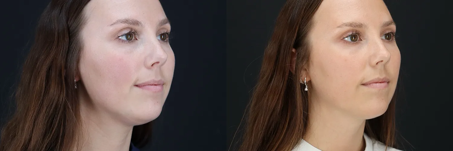 Before and after – Coolsculpting – Female patient, age 20-29 – Image 5