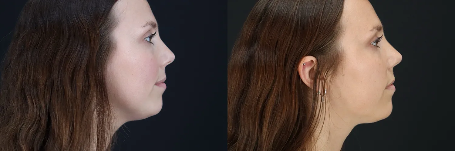 Before and after – Coolsculpting – Female patient, age 20-29 – Image 6