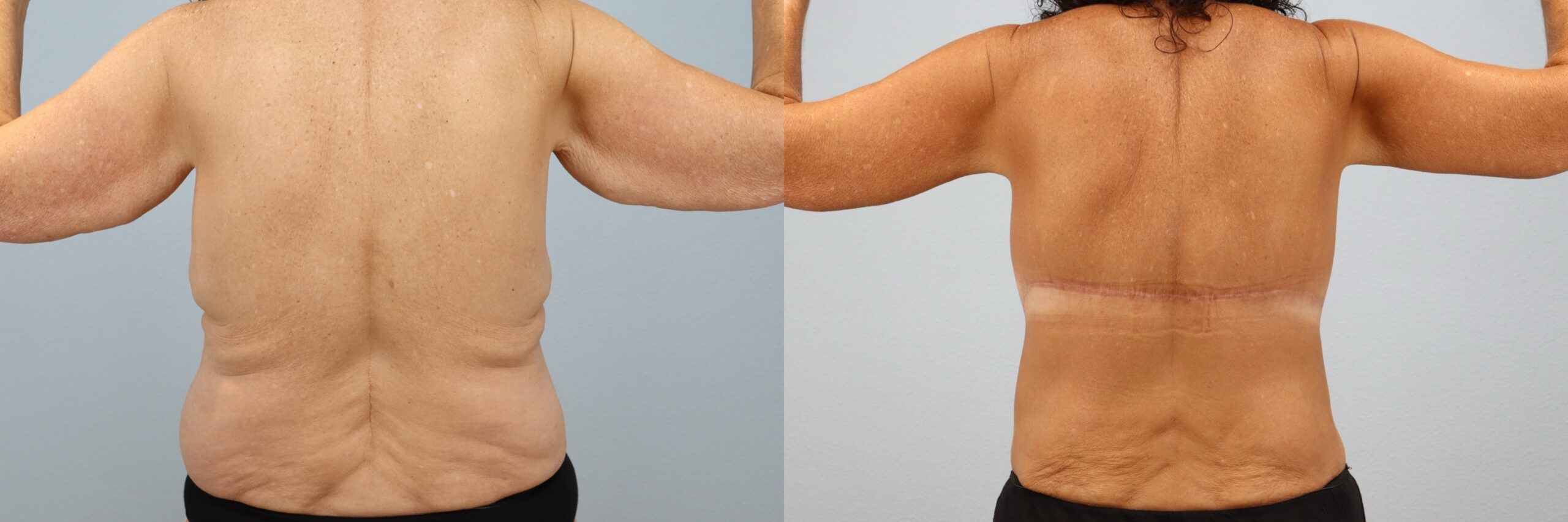 Before and after – Bra Line Back Lift – Female patient, age 60+ – Image 8