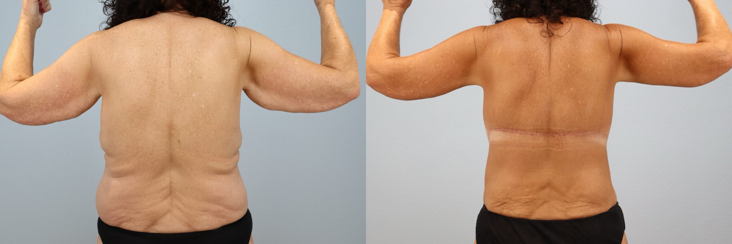 Before and after – Arm Lift – Female patient, age 60+ – Image 26
