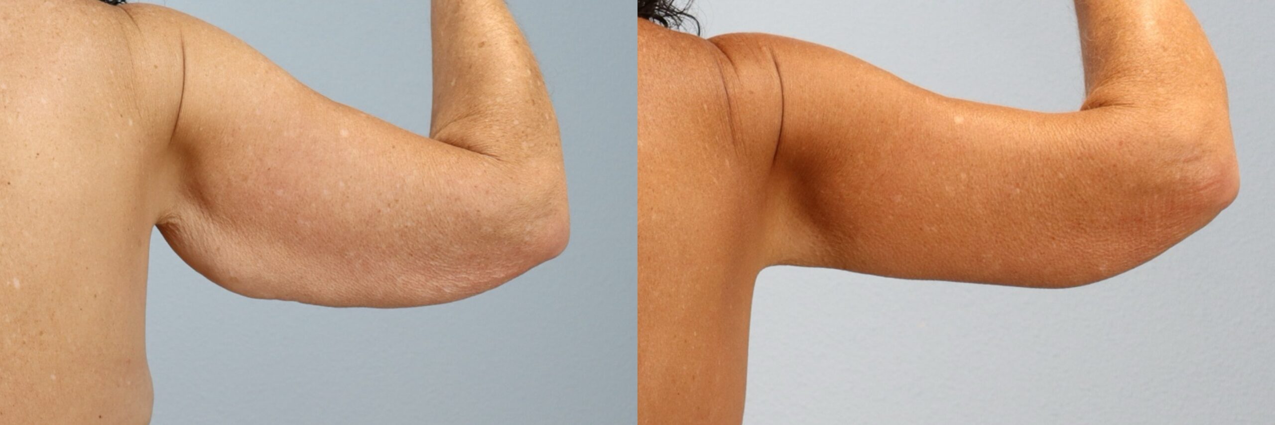 Before and after – Arm Lift – Female patient, age 60+ – Image 27