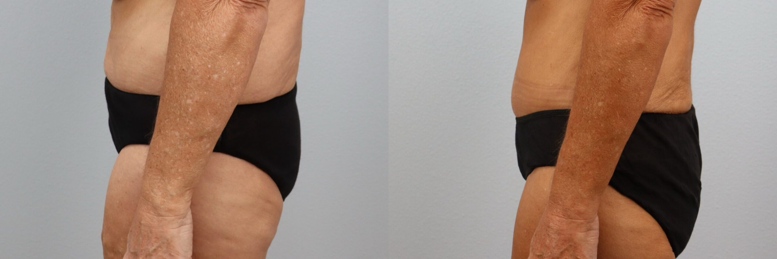 Before and after – Tummy Tuck – Female patient, age 60+ – Image 24