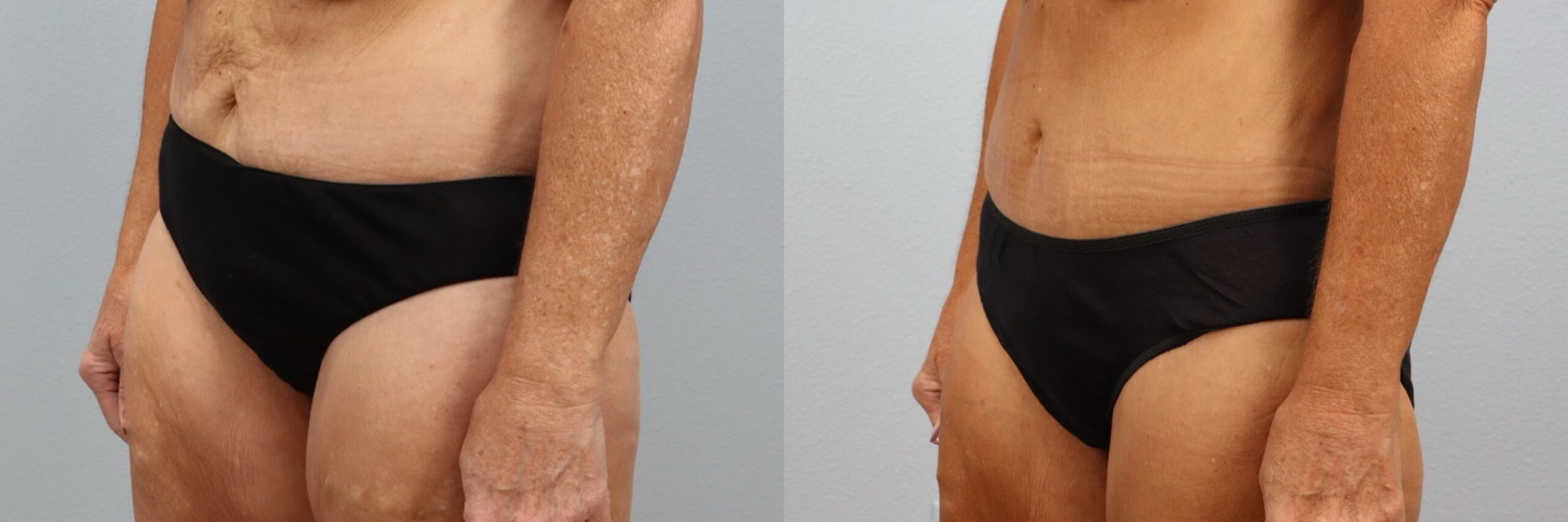 Before and after – Tummy Tuck – Female patient, age 60+ – Image 23