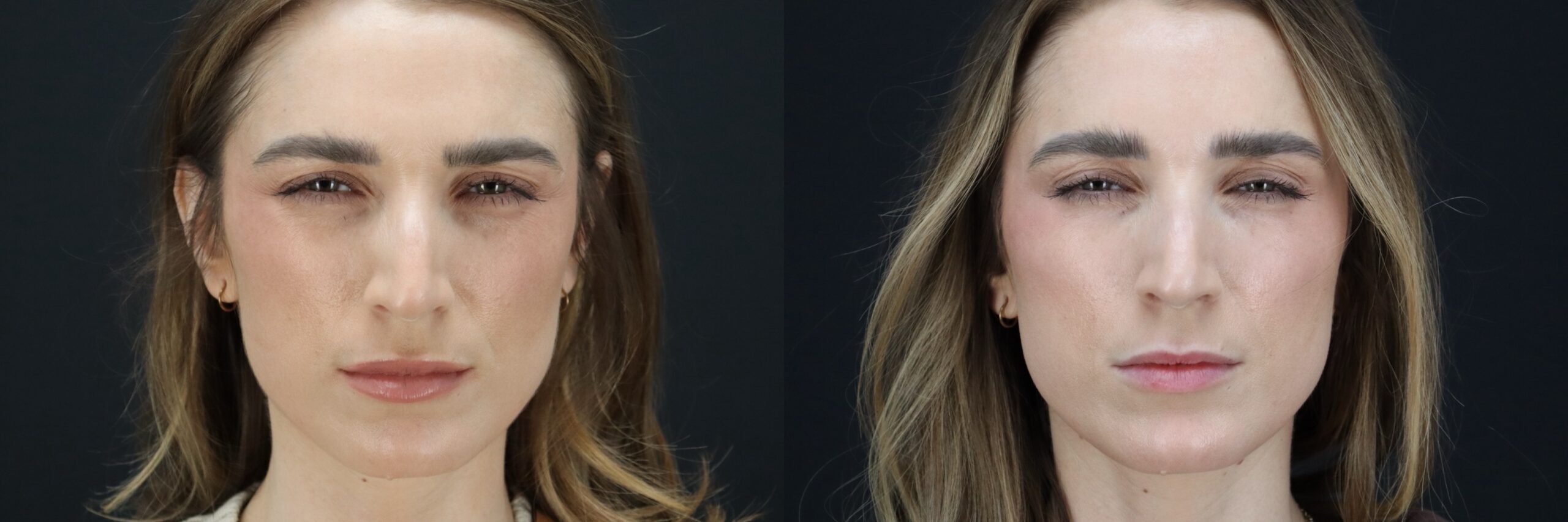 Before and after – BOTOX – Female patient, age 30-39 – Image 24