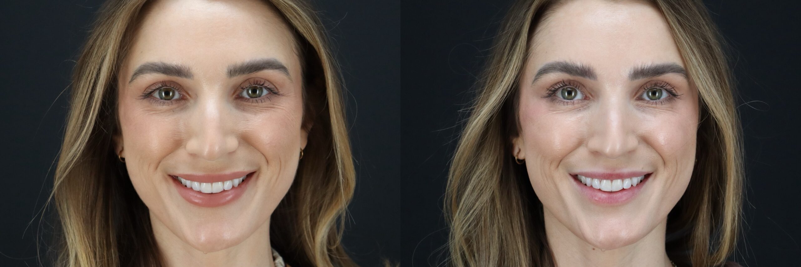 Before and after – BOTOX – Female patient, age 30-39 – Image 23
