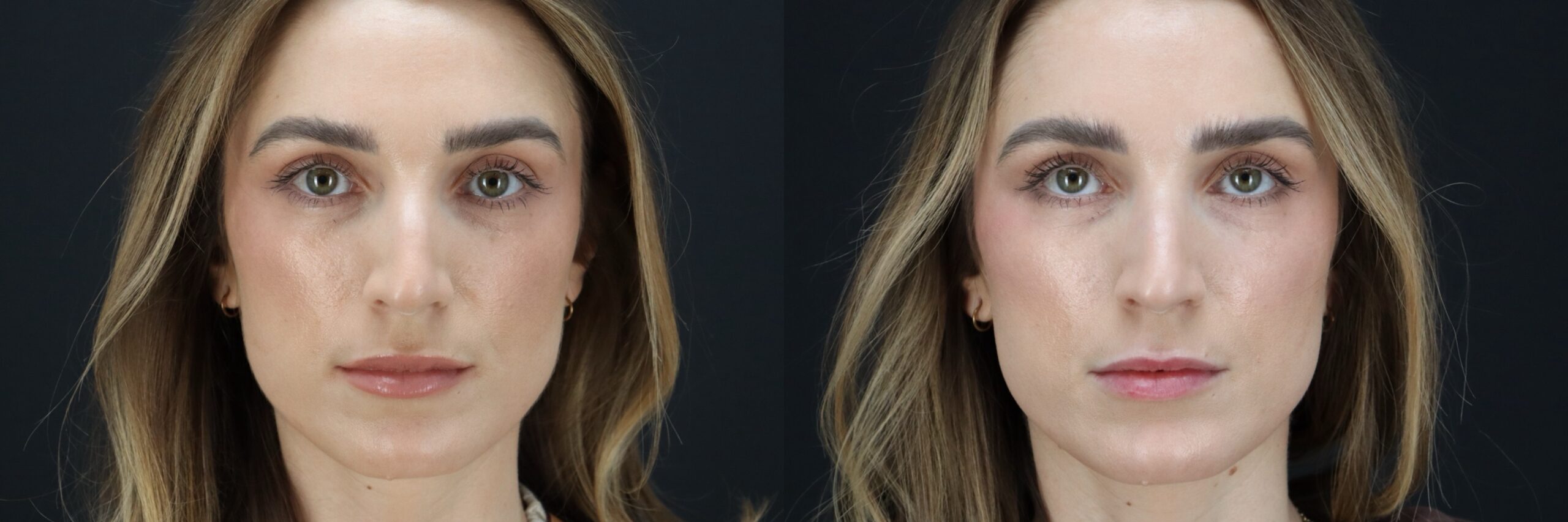 Before and after – BOTOX – Female patient, age 30-39 – Image 22