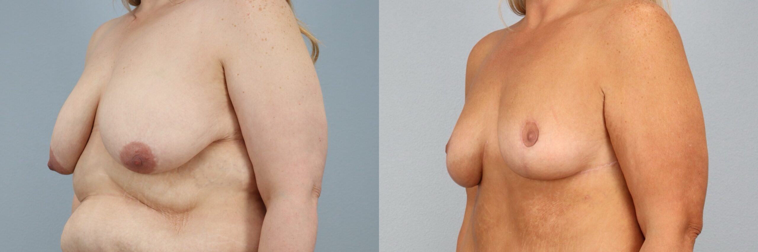 Before and after – Breast Surgery – Female patient, age 40-49 – Image 17