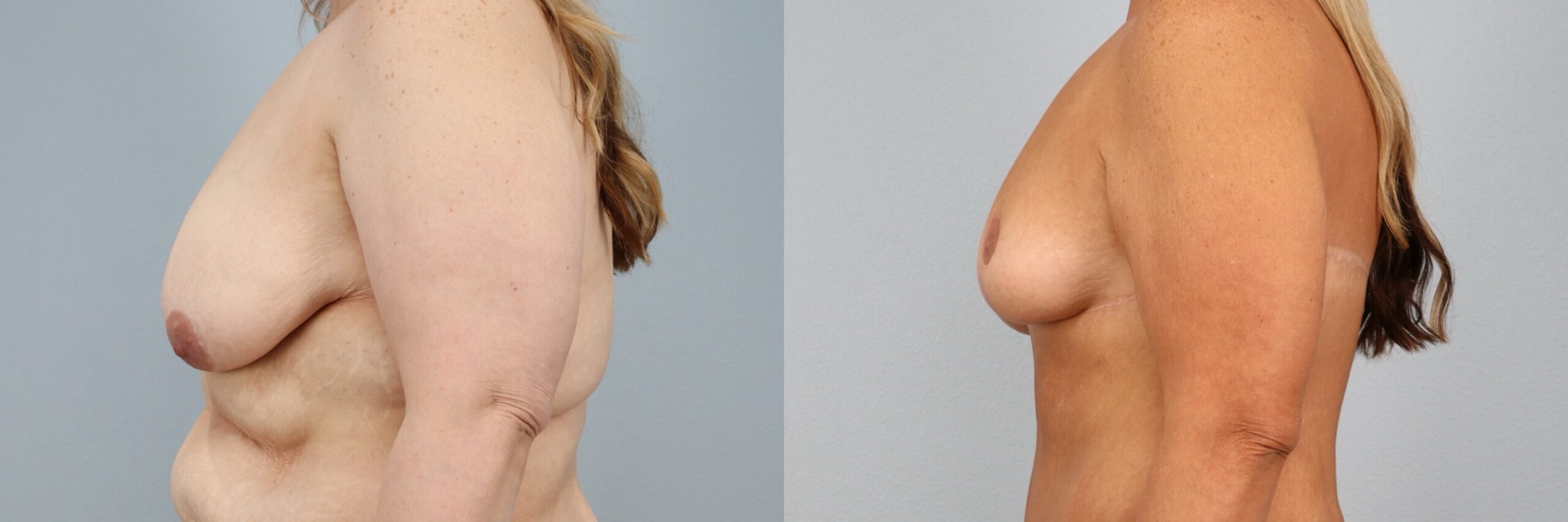 Before and after – Breast Surgery – Female patient, age 40-49 – Image 18