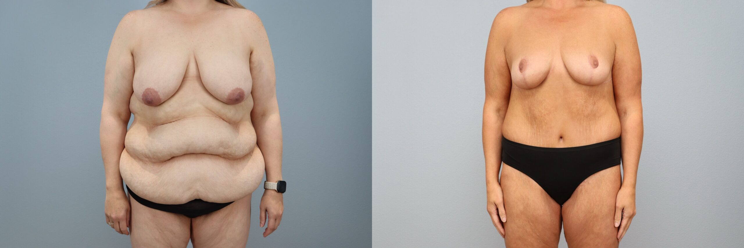 Before and after – Mommy Makeover – Female patient, age 40-49 – Image 10
