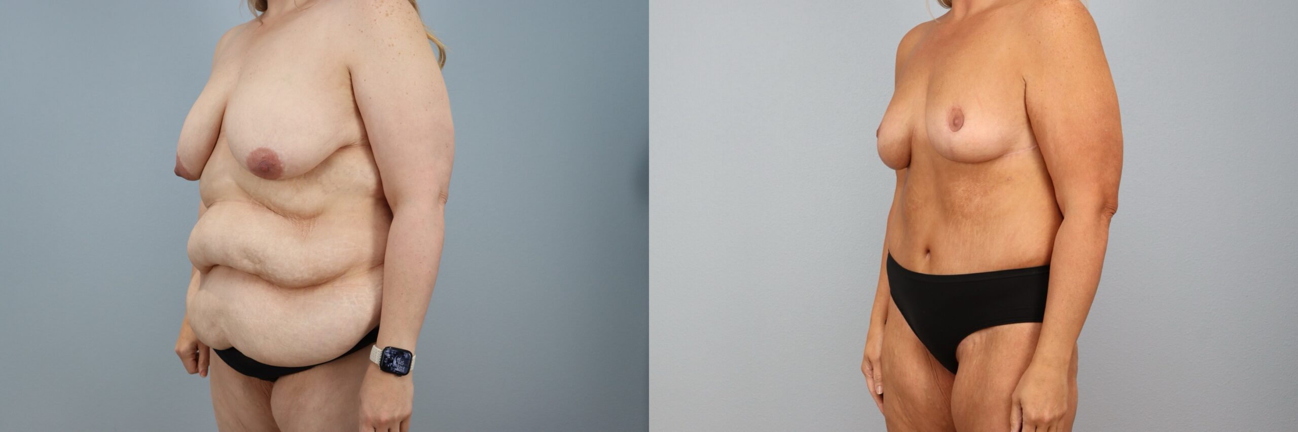 Before and after – Mommy Makeover – Female patient, age 40-49 – Image 11