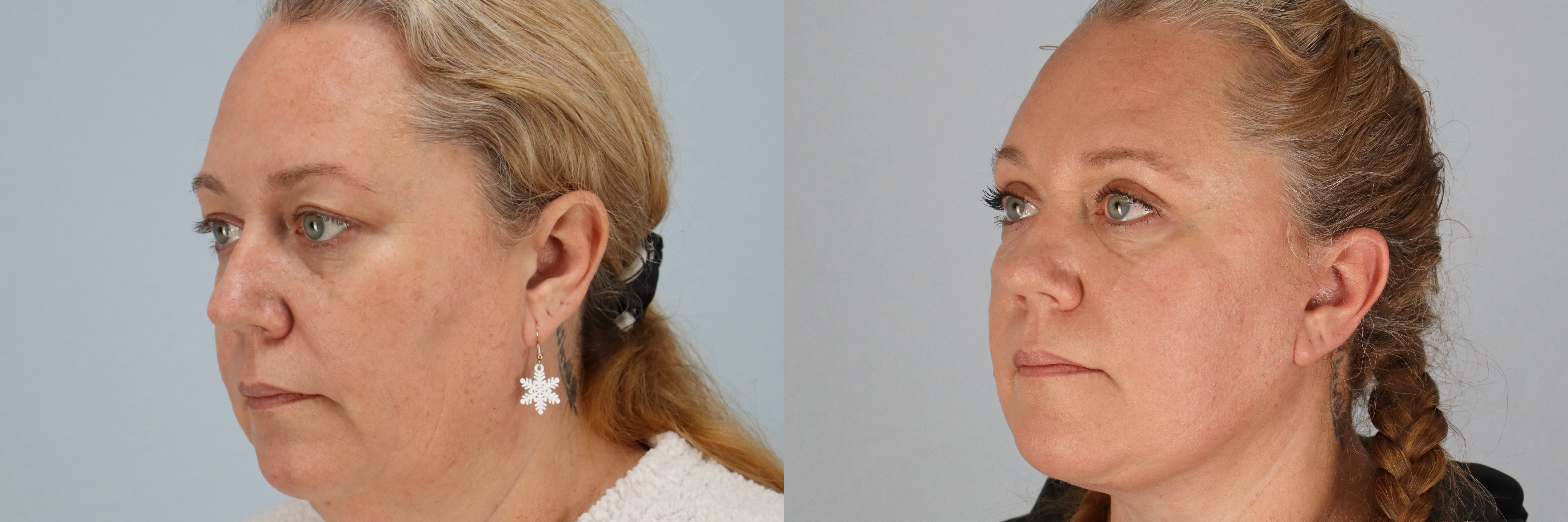 Before and after – Facelift Surgery – Female patient, age 40-49 – Image 8