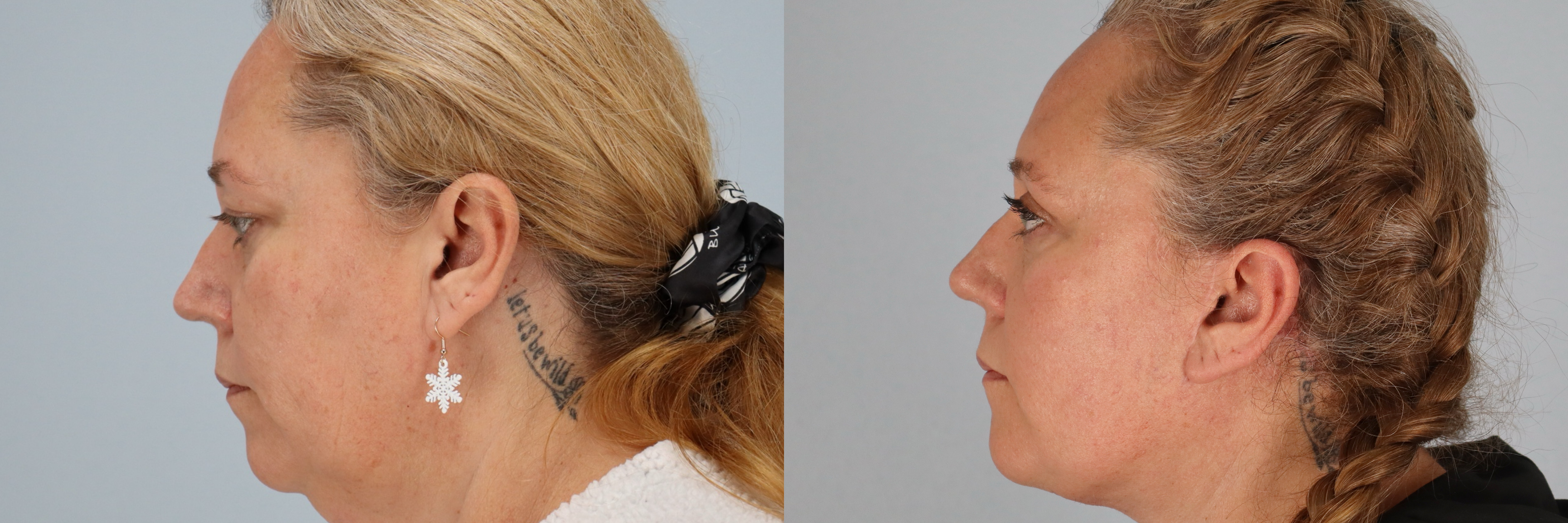 Before and after – Facelift Surgery – Female patient, age 40-49 – Image 9