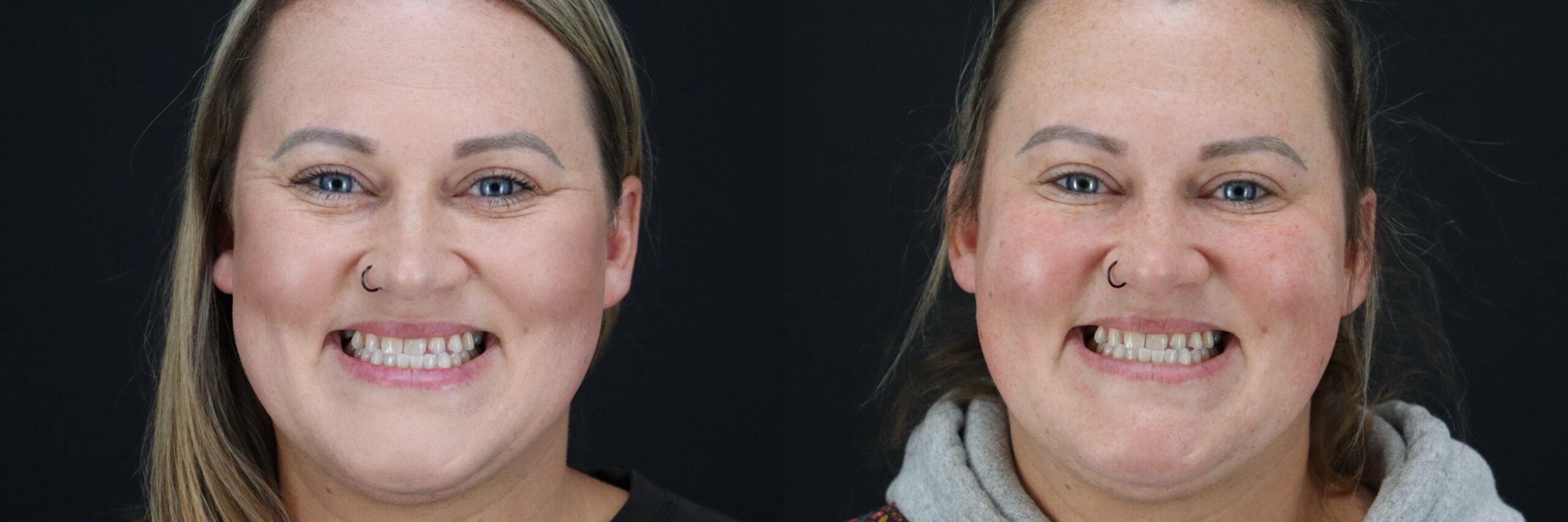 Before and after – BOTOX – Female patient, age 30-39 – Image 19