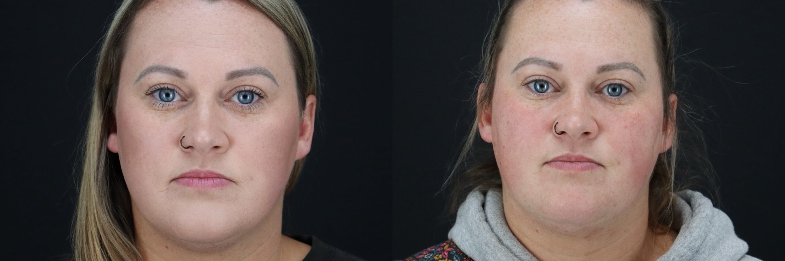 Before and after – BOTOX – Female patient, age 30-39 – Image 18