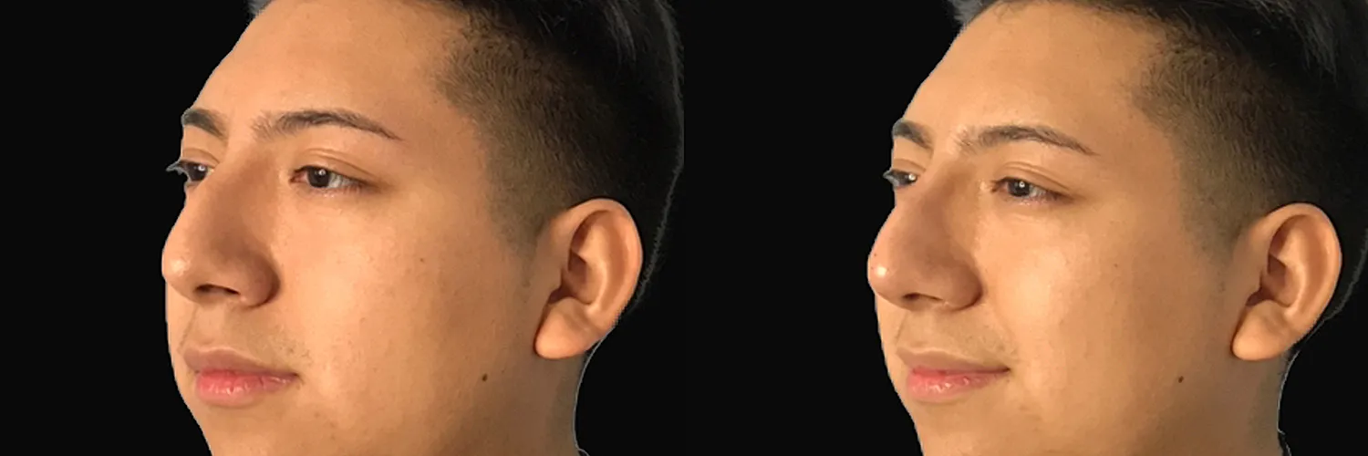 Before and after – Non-Surgical Rhinoplasty – Female patient, age 20-29 – Image 5