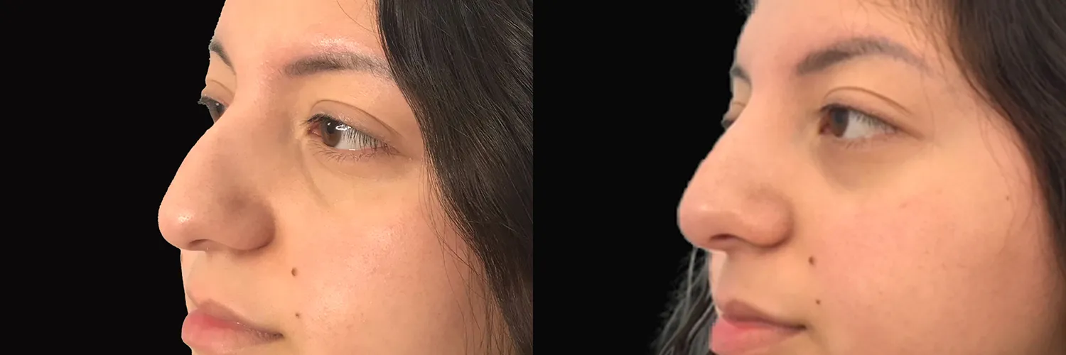 Before and after – Non-Surgical Rhinoplasty – Female patient, age 20-29 – Image 2