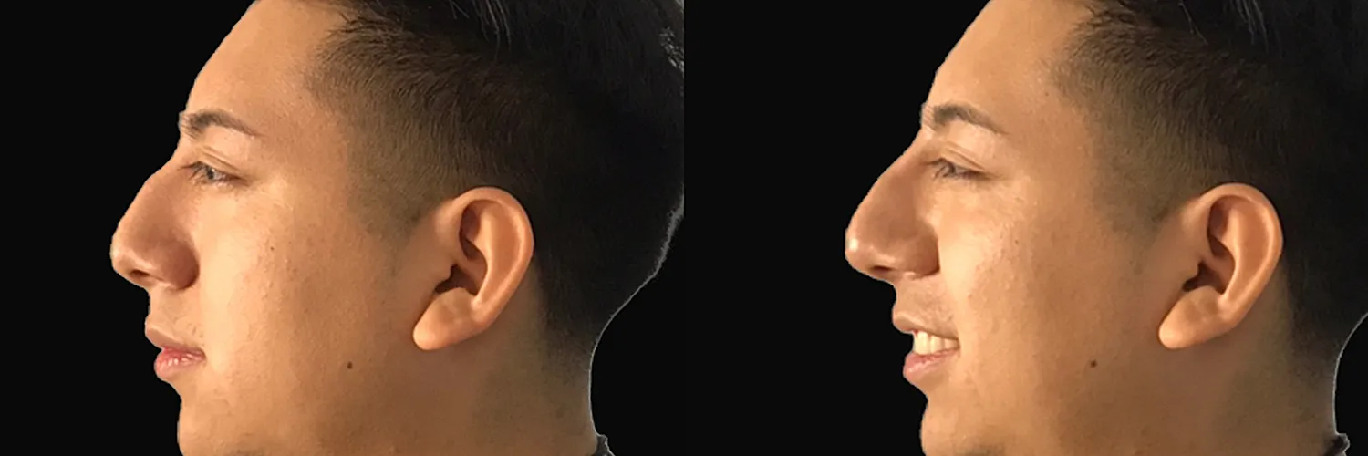 Before and after – Non-Surgical Rhinoplasty – Female patient, age 20-29 – Image 6