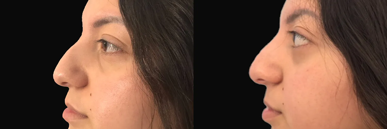 Before and after – Non-Surgical Rhinoplasty – Female patient, age 20-29 – Image 3