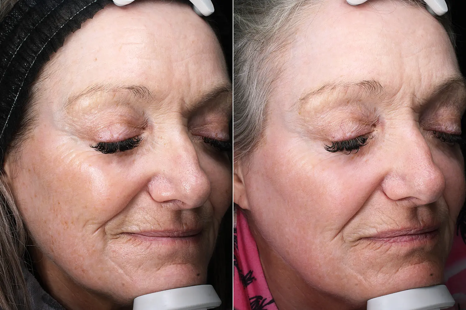 Before and after – Skin Tightening and Wrinkle Reduction – Female patient, age 40-49 – Image 2