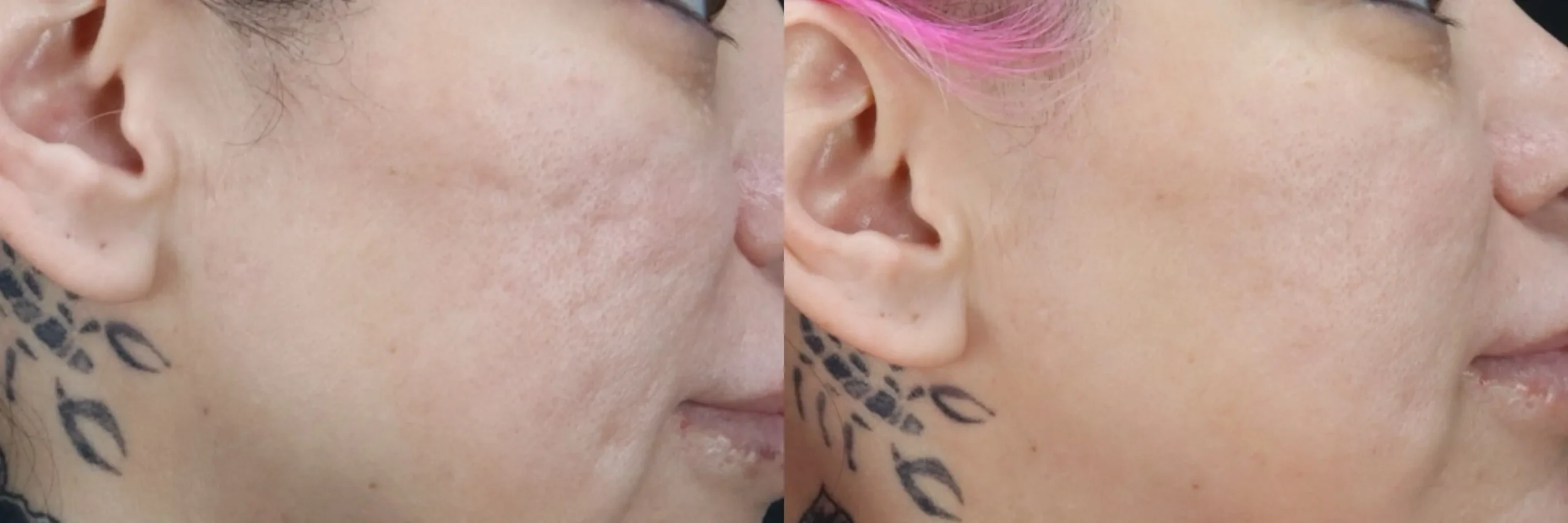 Before and after – Medi Spa – Female patient, age 30-39 – Image 28