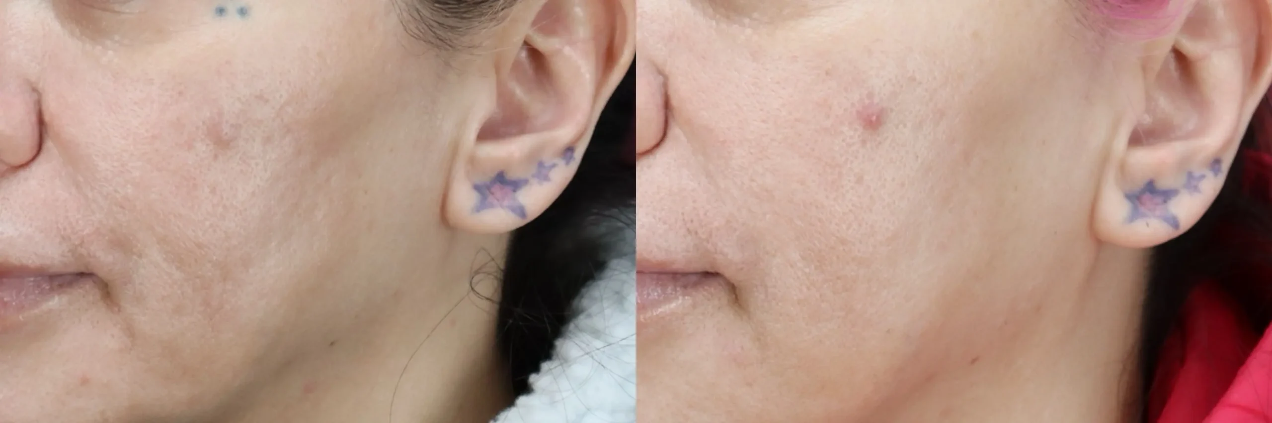 Before and after – Medi Spa – Female patient, age 30-39 – Image 29