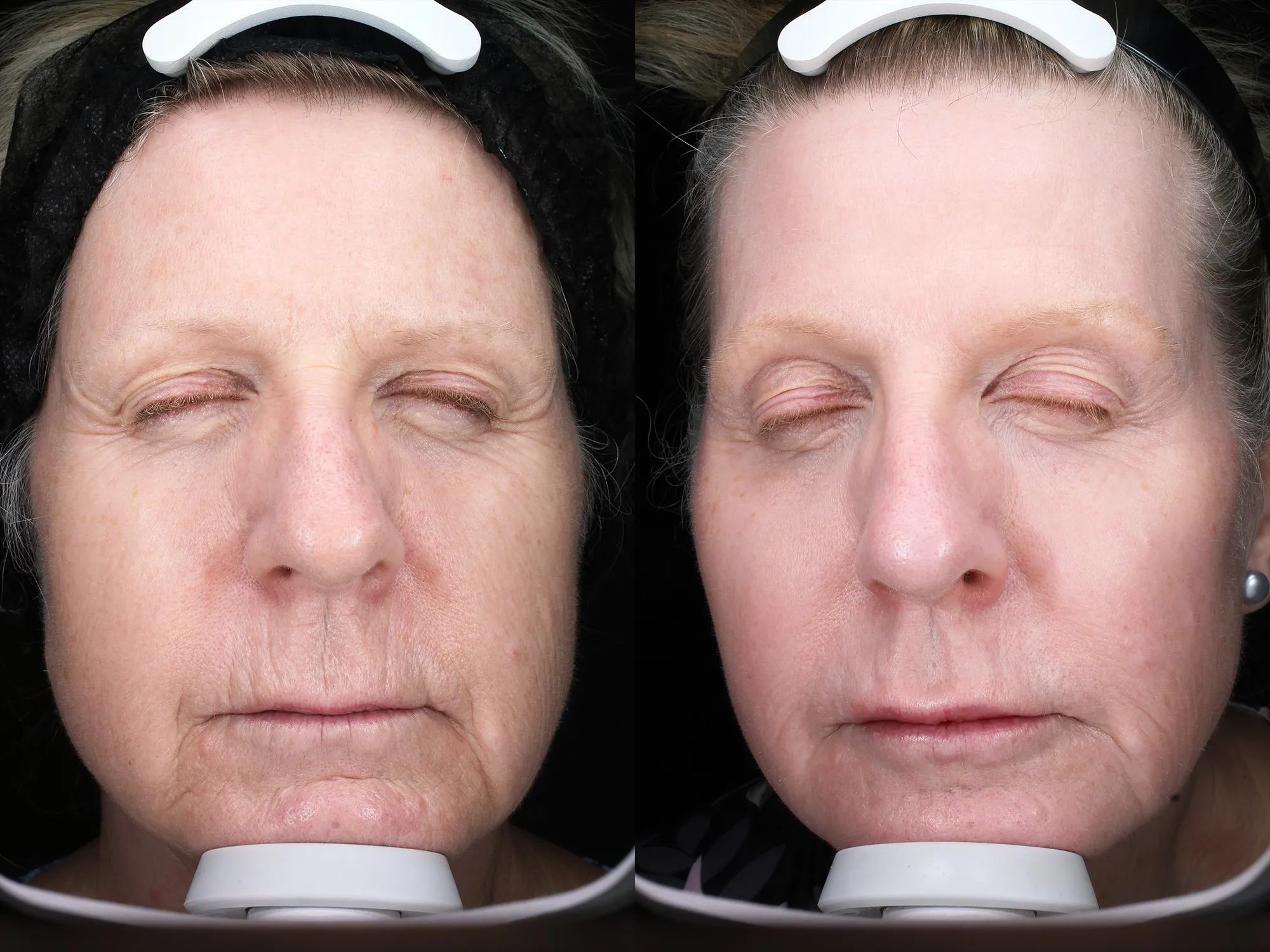 Before and after – Coolsculpting – Female patient, age 50-59 – Image 1