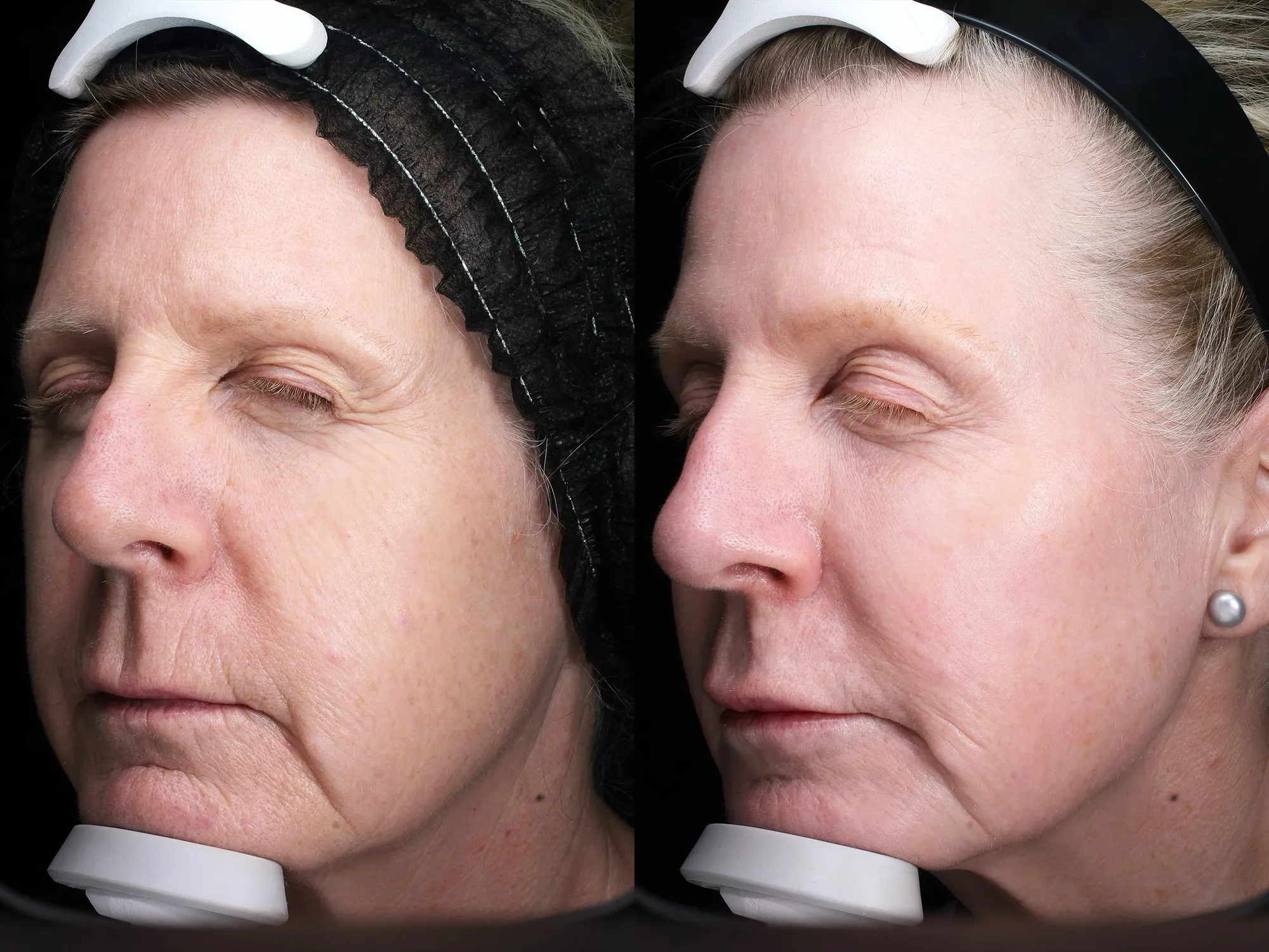 Before and after – Coolsculpting – Female patient, age 50-59 – Image 3
