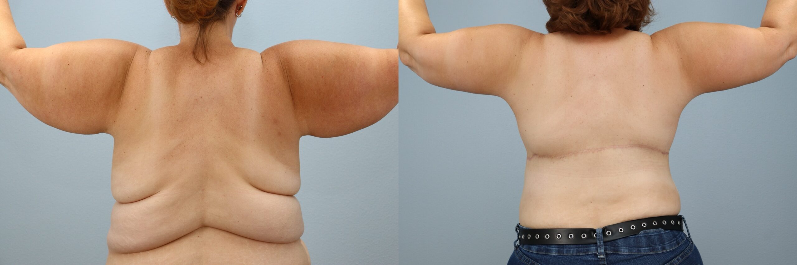 Before and after – Arm Lift – Female patient, age 40-49 – Image 4