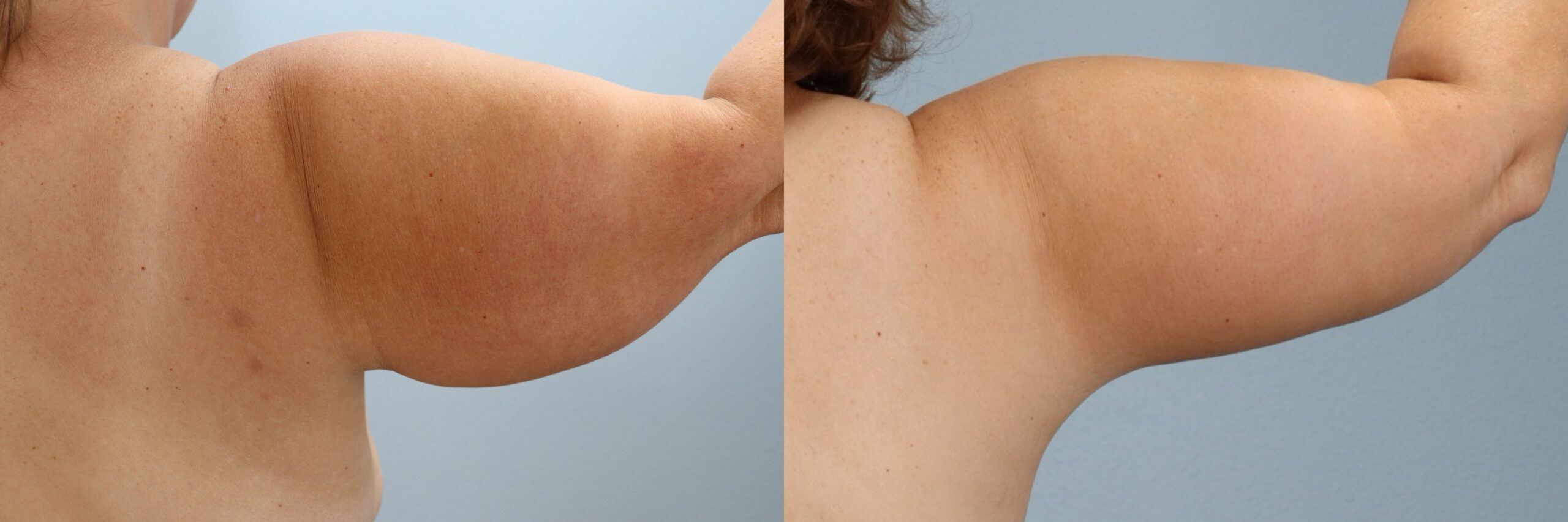 Before and after – Arm Lift – Female patient, age 40-49 – Image 5