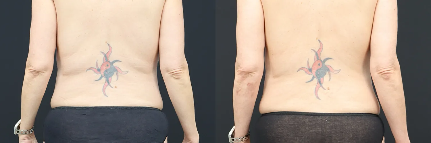 Before and after – Coolsculpting – Female patient, age 30-39 – Image 7