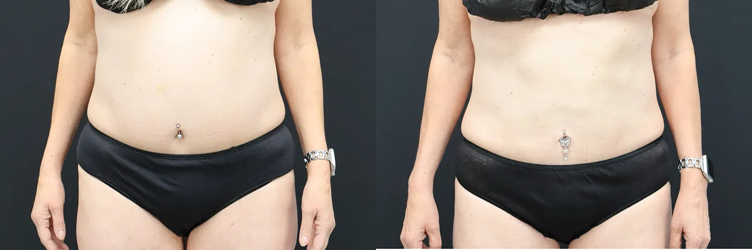 Before and after – Coolsculpting – Female patient, age 30-39 – Image 8