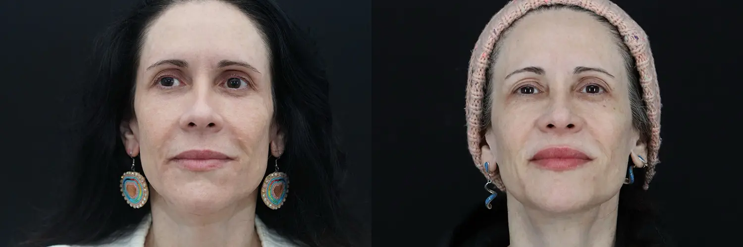 Before and after – Medi Spa – Female patient, age 30-39 – Image 37