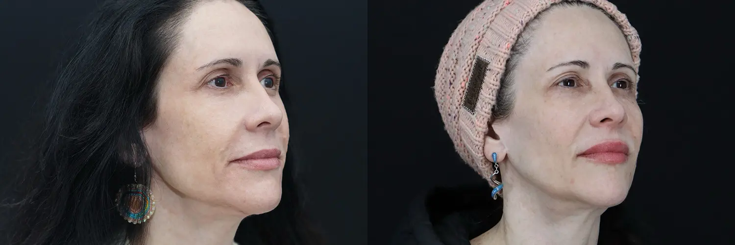 Before and after – Medi Spa – Female patient, age 30-39 – Image 38