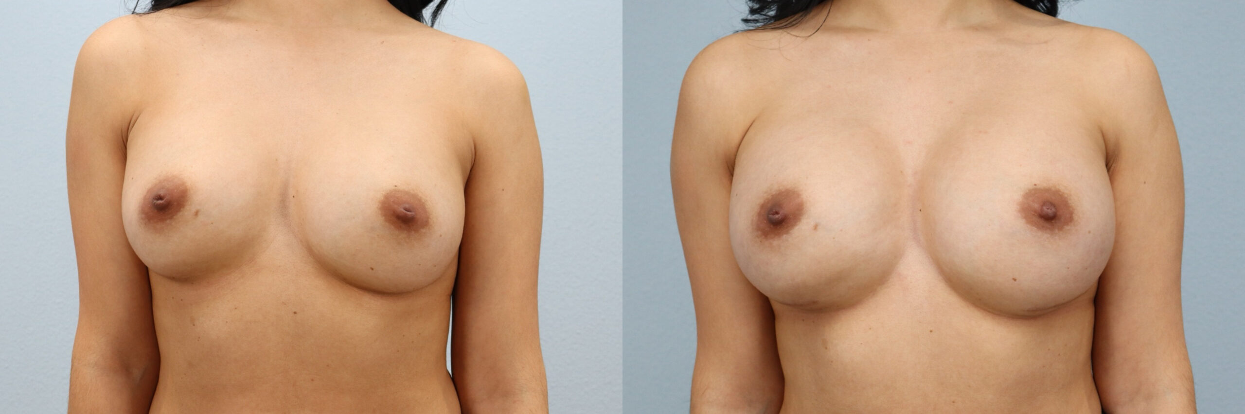Before and after – Breast Revision – Female patient, age 30-39 – Image 31