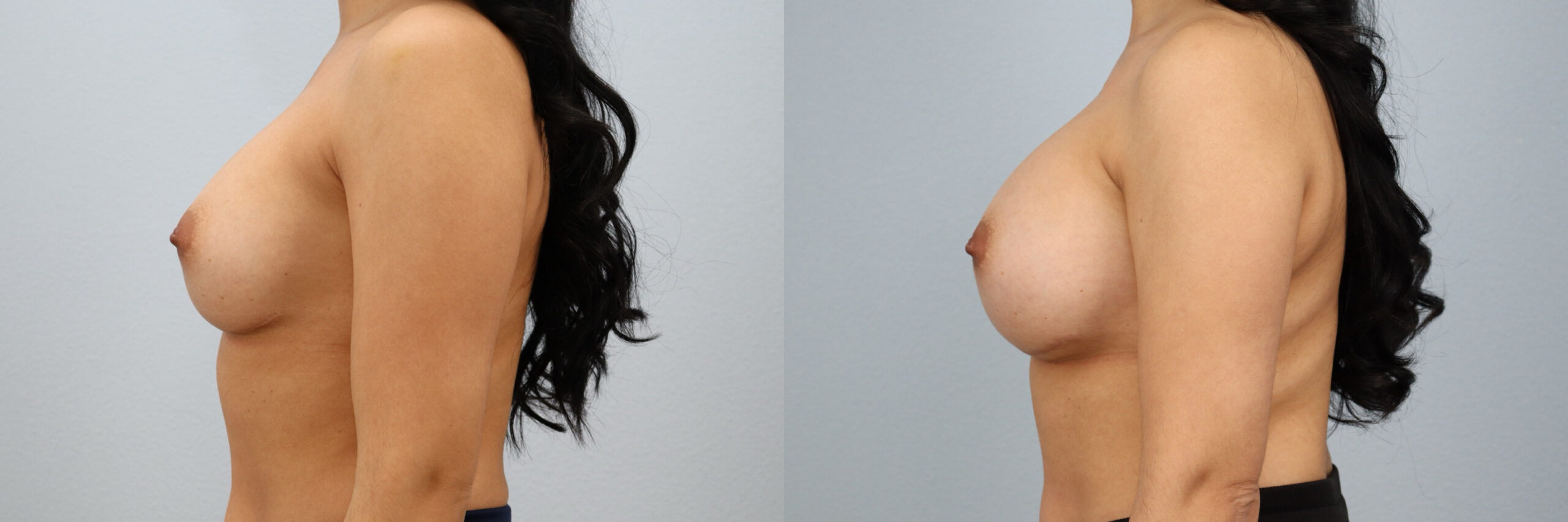 Before and after – Breast Revision – Female patient, age 30-39 – Image 33