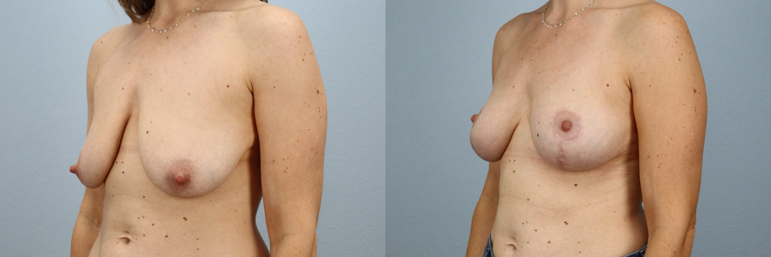 Before and after – Breast Lift – Female patient, age 30-39 – Image 23