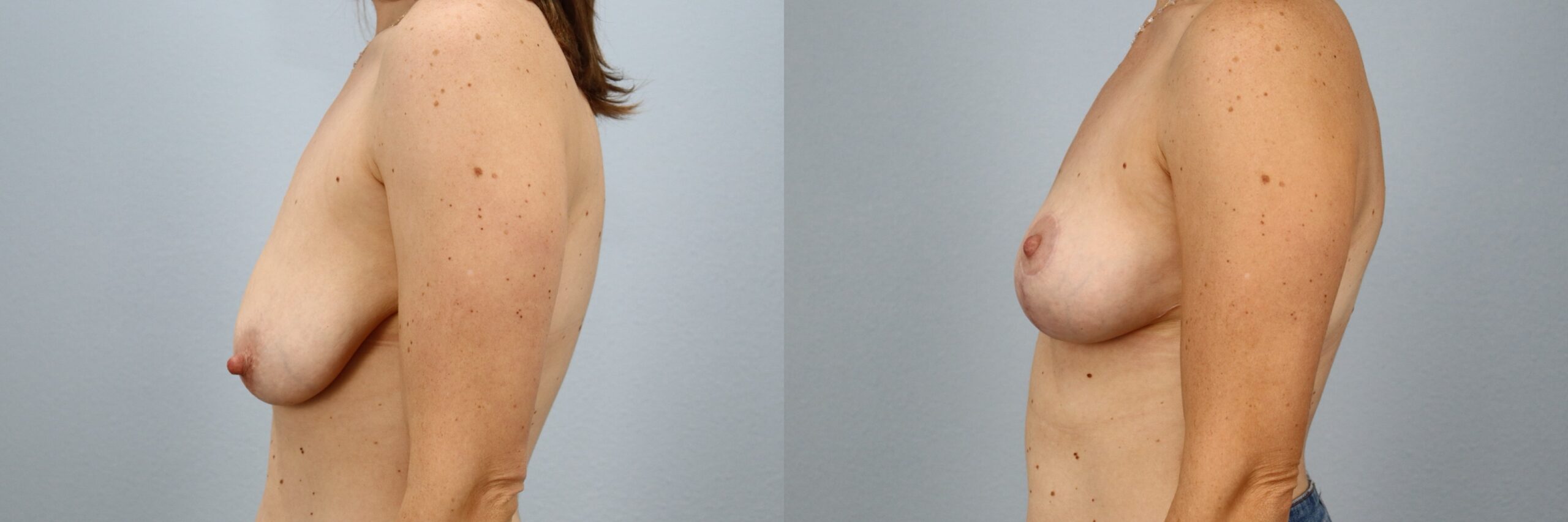 Before and after – Breast Lift – Female patient, age 30-39 – Image 24